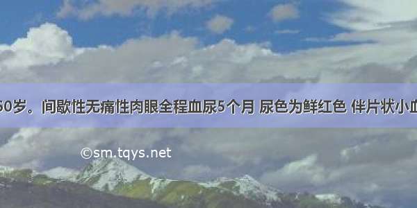 女性 60岁。间歇性无痛性肉眼全程血尿5个月 尿色为鲜红色 伴片状小血凝块。